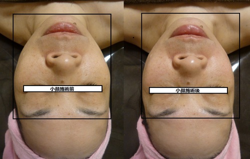 nakatamariko(Facial)haba.目隠し.jpg